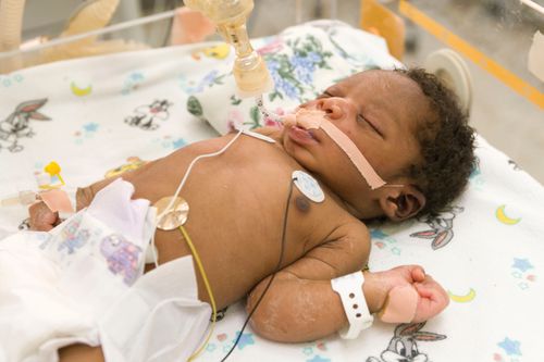 A premature baby lies sleeping under neonatal care in a hospital, with tubes attached to her to help her breathe.